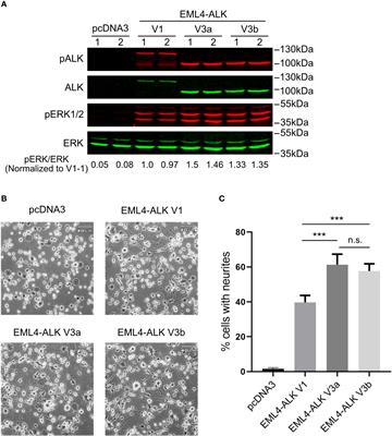 ALK F1174S mutation impairs ALK kinase activity in EML4-ALK variant 1 and sensitizes EML4-ALK variant 3 to crizotinib